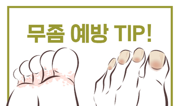 무좀 예방 TIP !!
