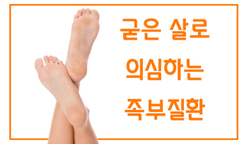 굳은 살로 의심하는 족부질환