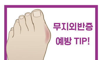 무지외반증 예방 TIP !!